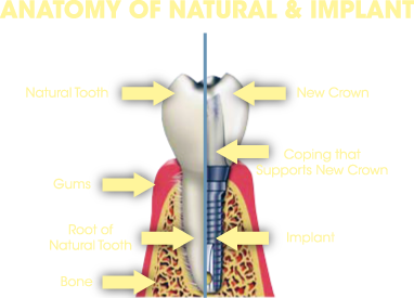 implantb